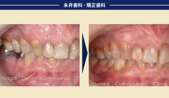 50代女性。インプラントが出来ない、でも噛みたい。「小さく装着感のよいブリッジ」という選択