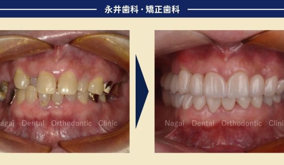 西宮市在住60代女性。見た目もきれいな噛み合わせを考えた、インプラント治療