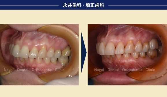 60代女性。入れ歯しかないと言われたけれど、インプラント治療を無事に終了