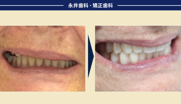 芦屋市在住80代女性。上下総入れ歯『入れ歯が食事中に動いて外れる』を解消したい