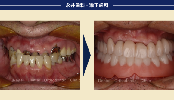60代男性。かみ合わせの違和感がなくなった。反対咬合を改善した入れ歯とインプラント治療。