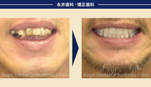 50代男性。グラグラで噛めない状態からの脱却