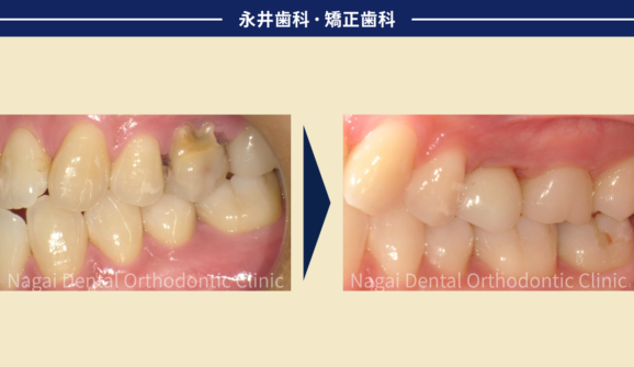 20代女性。自身の歯の将来を考えてブリッジではなくインプラント治療を選択