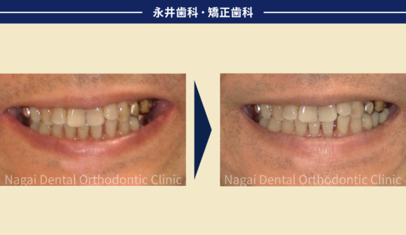 50代男性。左ばかり歯を失うのはなぜ?噛み合わせを重視したインプラント治療