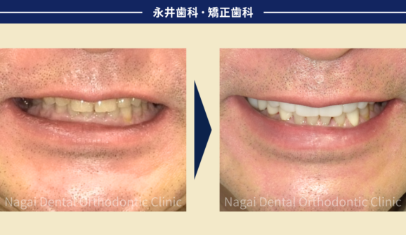 60代男性。インプラントで美味しく食事が楽しめる