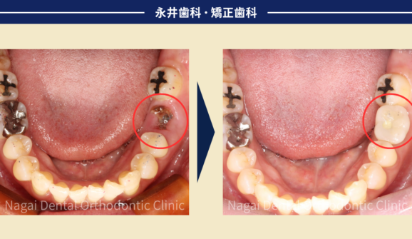50代女性。奥歯1本に抜歯即時インプラント、奥歯の悩みを短期間で解消