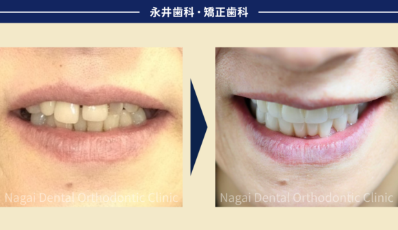 60代女性。誕生日に決断。笑顔を取り戻せたインプラント治療